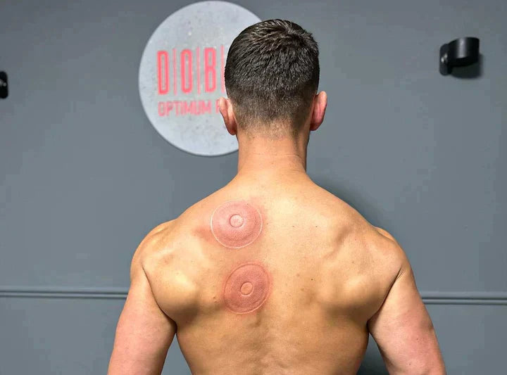 SmartCup – Smart Cupping Therapy Device